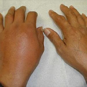 What Should I Know About Uric Acid Diet - Treatment With Regard To Gout