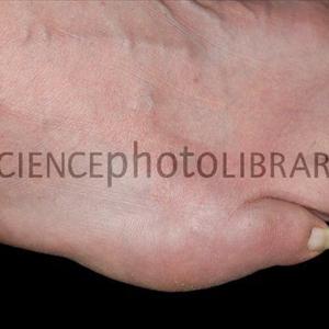 Herbs For Uric Acid - Gout Pain Treatment