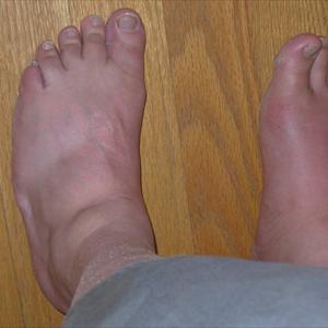 What Is The Meaning Of 6Mgdl - Just What Are Definitely The Most Advantageous Home Remedies Suitable For Retrieving Gout?