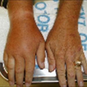 How Long Does Gout Last For - Oranges Seeds: A Great Gout Option Through Original Stage