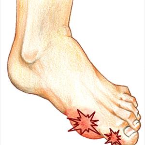 Foods Rich In Uric Acid - Painful Joint Inflammation Gout Is Caused By Uric Acid Accumulation