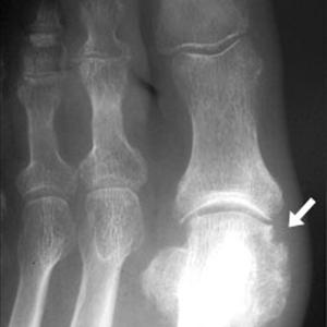 Should You Put Weight On A Gout Joint - What Will Happen If Gout Or High Uric Acid Is Left Untreated