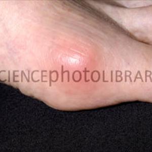 Gout Exer - Remedies For Gout You Ought To Know