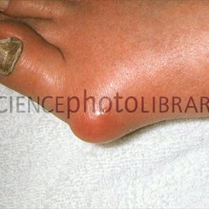 Gout Information - Natural Treatments For Gout - No More Pain &Amp; Inflammation