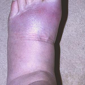 Citrus Acid And Gout 