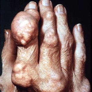 Stop Gout Pain - Gout: Brand New Treatments And Suggestions For Prevention