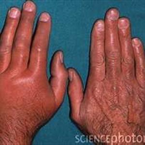 Gout Menu - Flexcin Evaluation Natural Remedy For Arthritis, Rheumatoid Arthritis And Gout Pain Relief