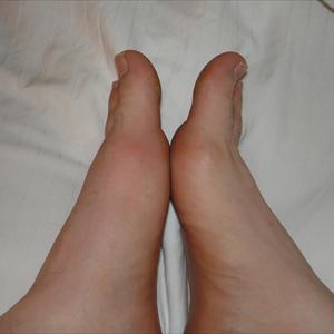 Celery Gout - Gout Treatment -- The Best Way To Halt In Which Throbbing Agony At This Point