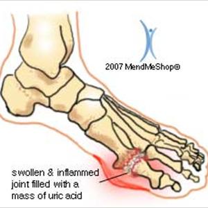 Does Goutezol Work 