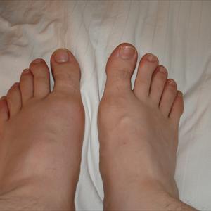 Turkey Gout - Cause Of Gout Could Also Predict Cardiovascular Failure