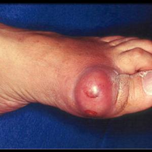 Is There A Way To Monitor Uric Acid Level At Home - Natural Remedies With Regard To Gout - No More Pain &Amp; Inflammation