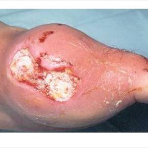 Turkey Gout - Cause Of Gout Might Also Predict Center Failure