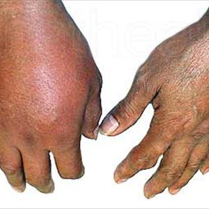 Natural Treatment For Pseudo Gout - Corticosteroids : Right Next Medical Treatment To Nsaids In Gout Cure