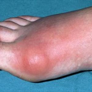 Acupuncture To Cure Gout - How To Get Respite From Common Foot Problems Bunions, Corns And More