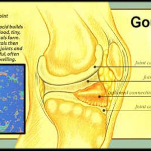 Amish Cure For Gout - Foods Regarding Gout