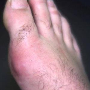 Stop Gout Pain - Gout: Brand New Treatments And Recommendations For Prevention