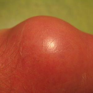Gout Treatment - What Happens When Uric Acid Increases?