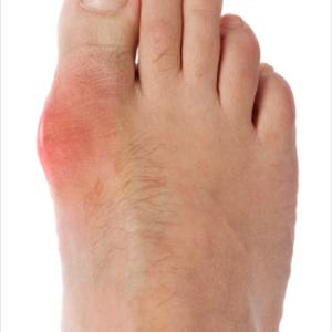 Citrus Acid And Gout - Do You Think Apple Cider Vinegar Treatment Is The Perfect Solution For Gout?